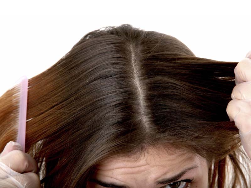 Các triệu chứng khi bị nhiễm nấm da đầu