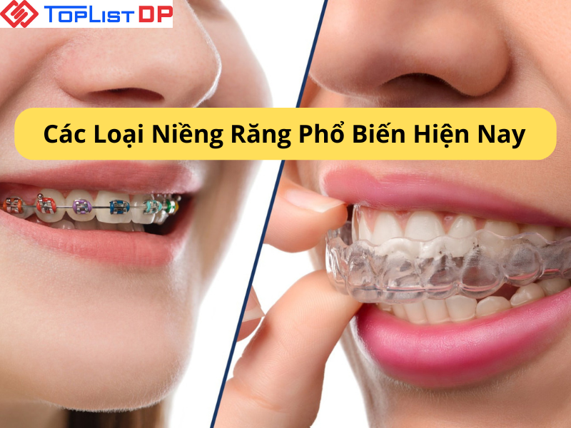 Các Loại Niềng Răng Phổ Biến Hiện Nay